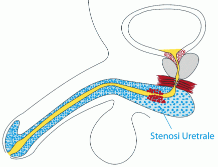 Stenosi uretrale